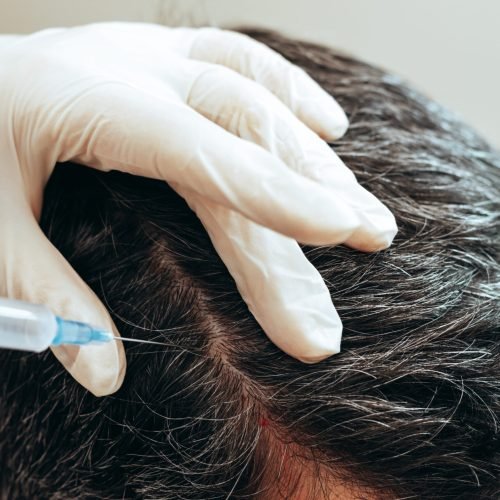 Cosmetologist performs anti-aging procedures injections hyaluronic acid into scalp, hair growth prevention hair loss man A cosmetologist performs anti-aging procedures, injections of hyaluronic acid into the scalp, for hair growth and prevention of hair loss in a man